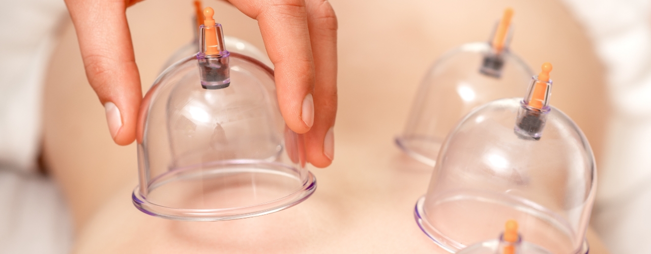 Cupping-therapy-MCR-Chiropractic-MA