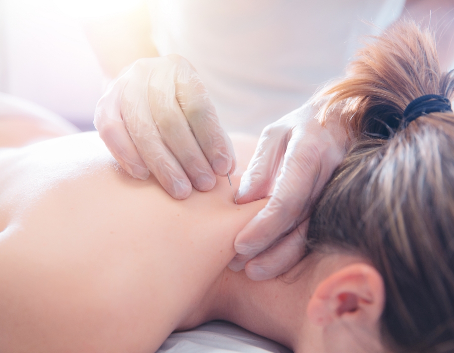 Chiropractor giving Acupuncture Therapy to patient's upper back. The patient is lying on their stomach.