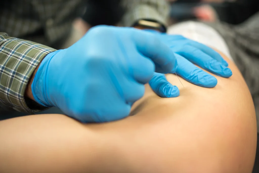Dry needling in action at MCR Chiropractic.