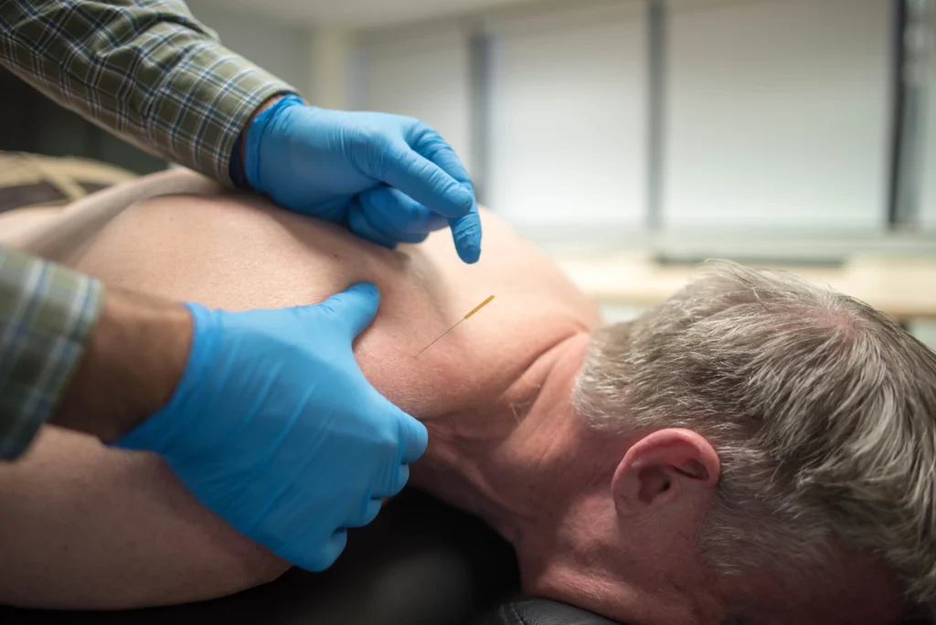 Patient receiving dry needling a MCR Clinic.