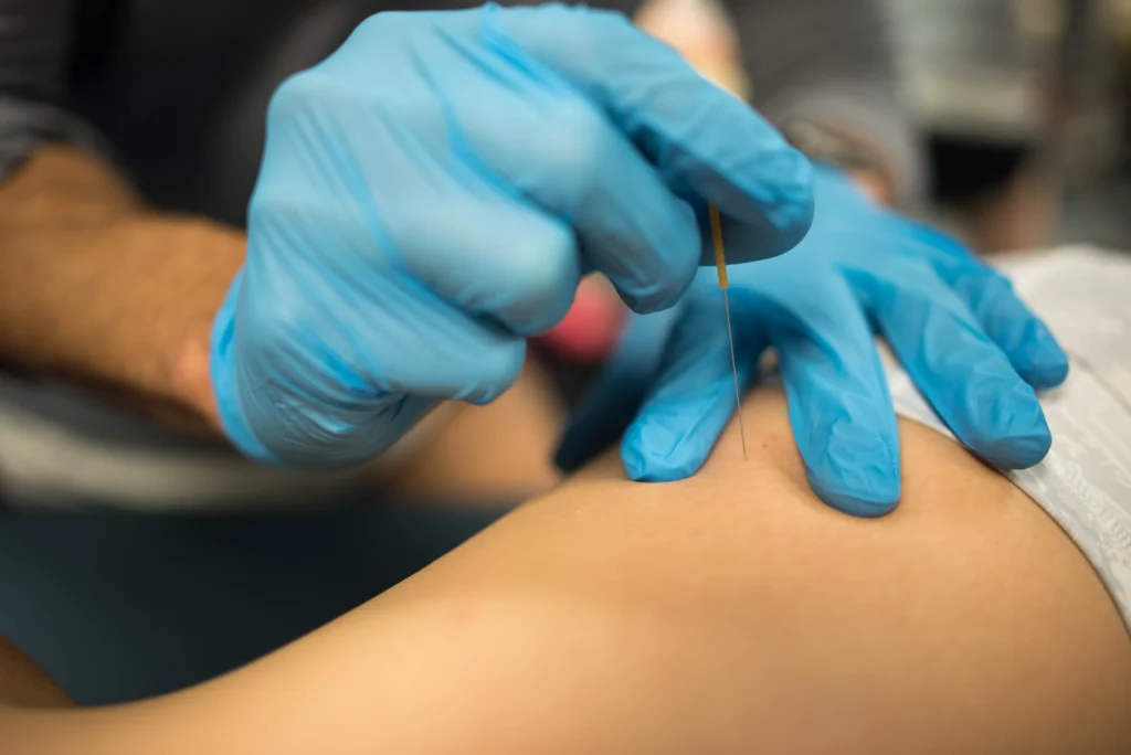 Patient receiving dry needling a MCR Clinic.